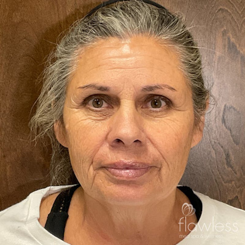 Scarlet RF Microneedling Before & After Gallery - Patient 376140 - Image 2