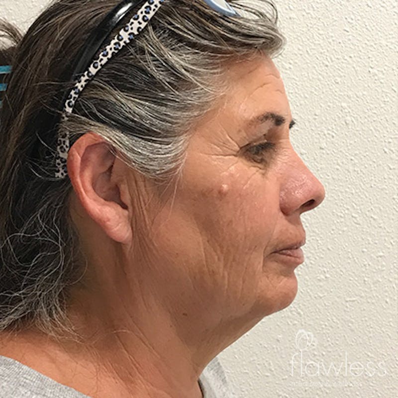 Scarlet RF Microneedling Before & After Gallery - Patient 376140 - Image 3