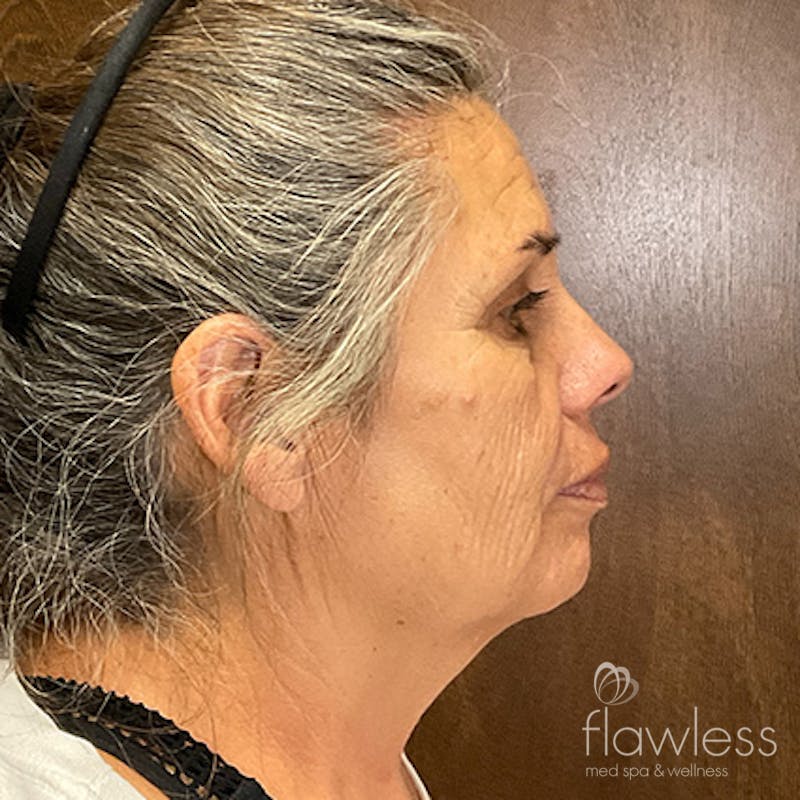 Scarlet RF Microneedling Before & After Gallery - Patient 376140 - Image 4