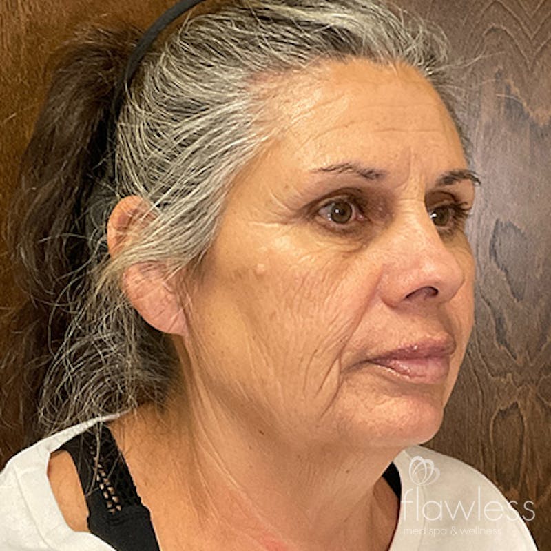 Scarlet RF Microneedling Before & After Gallery - Patient 376140 - Image 6