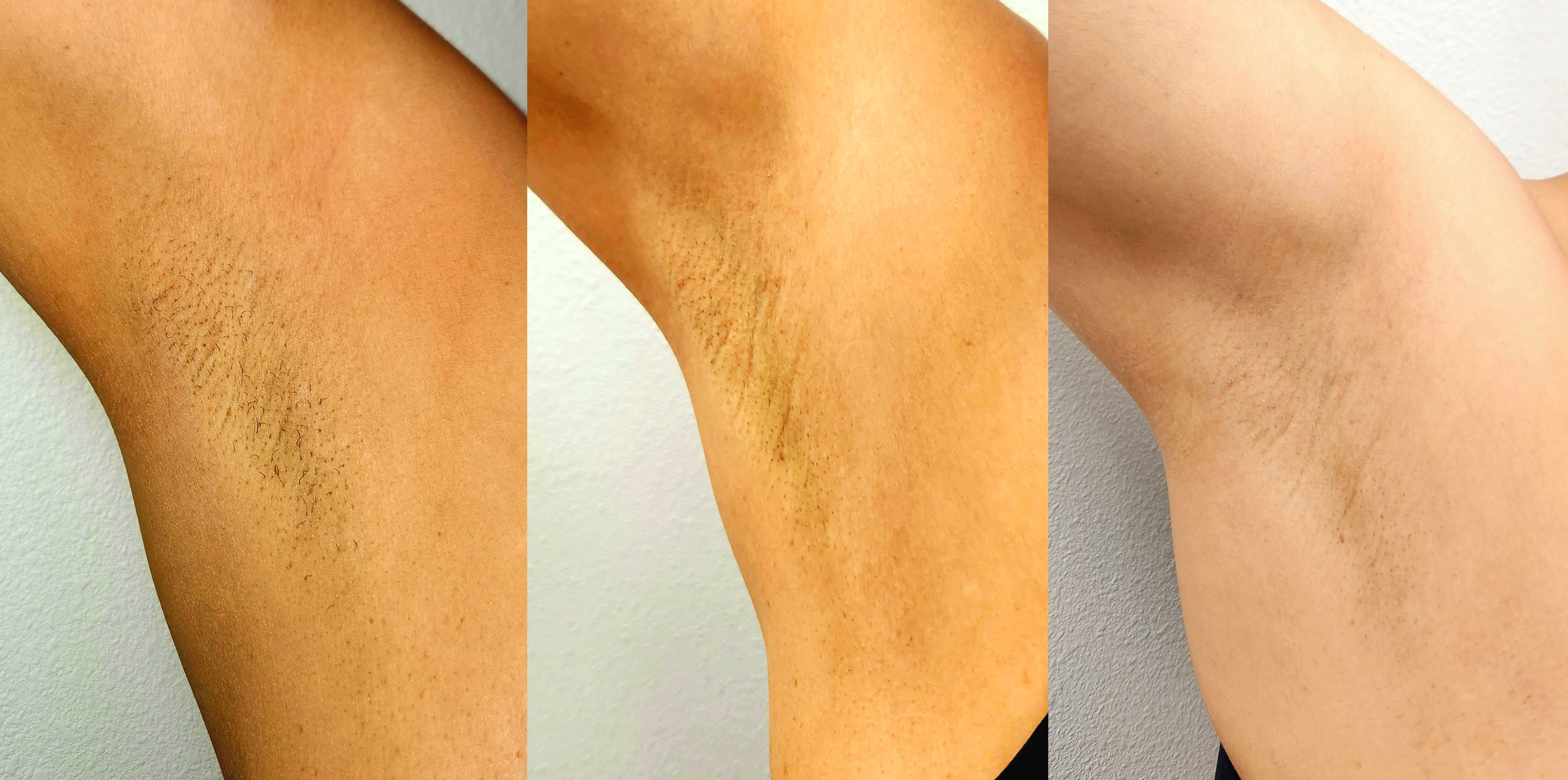 Laser Hair Removal Before & After