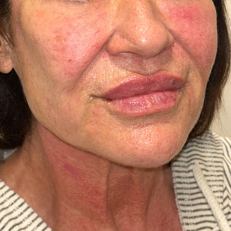 SkinVIVE Before & After Gallery - Patient 285273 - Image 2
