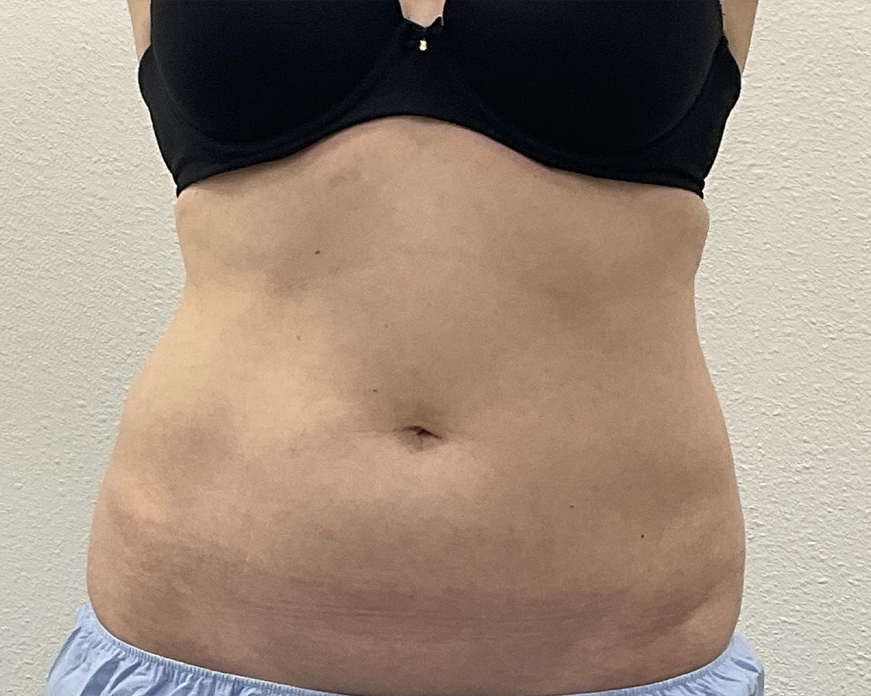Coolsculpting Before & After Gallery - Patient 227052 - Image 1
