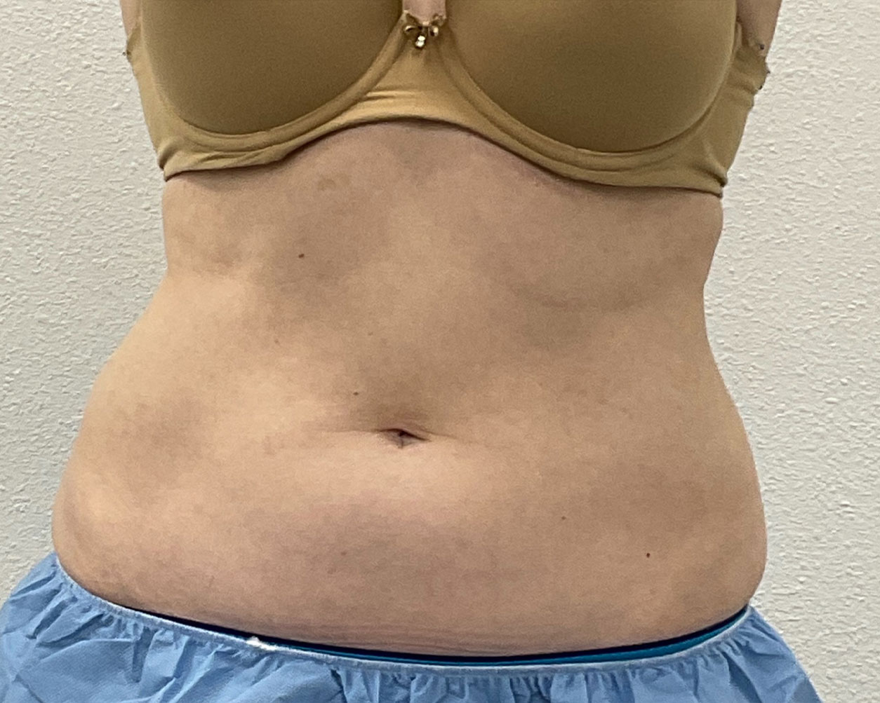 Coolsculpting Before & After Gallery - Patient 227052 - Image 2