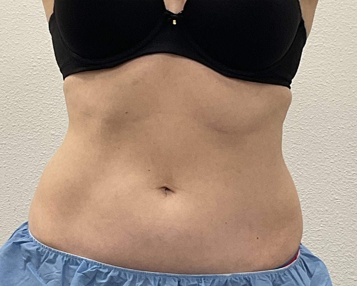 Coolsculpting Before & After Gallery - Patient 227052 - Image 4