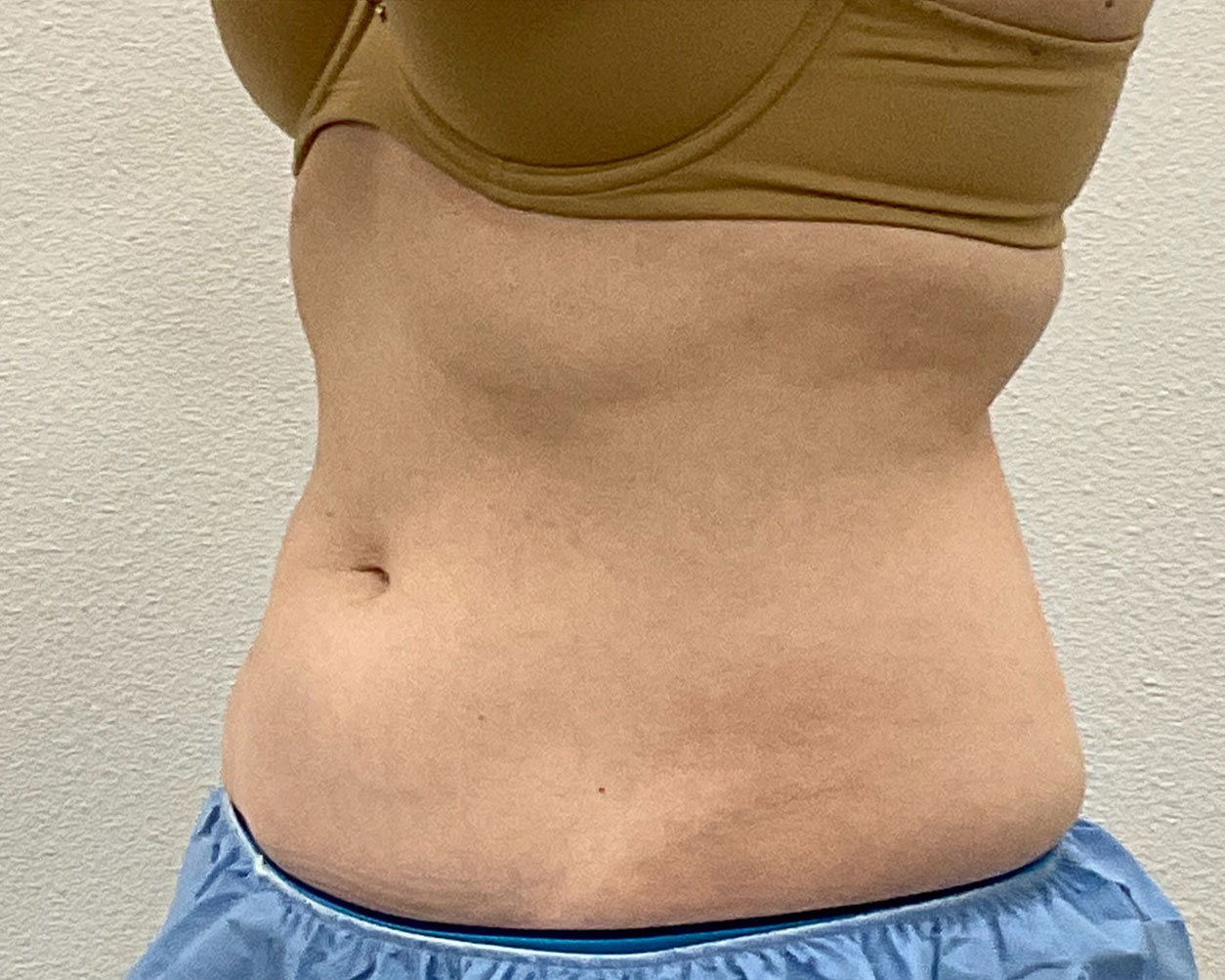 Coolsculpting Before & After Gallery - Patient 227052 - Image 6