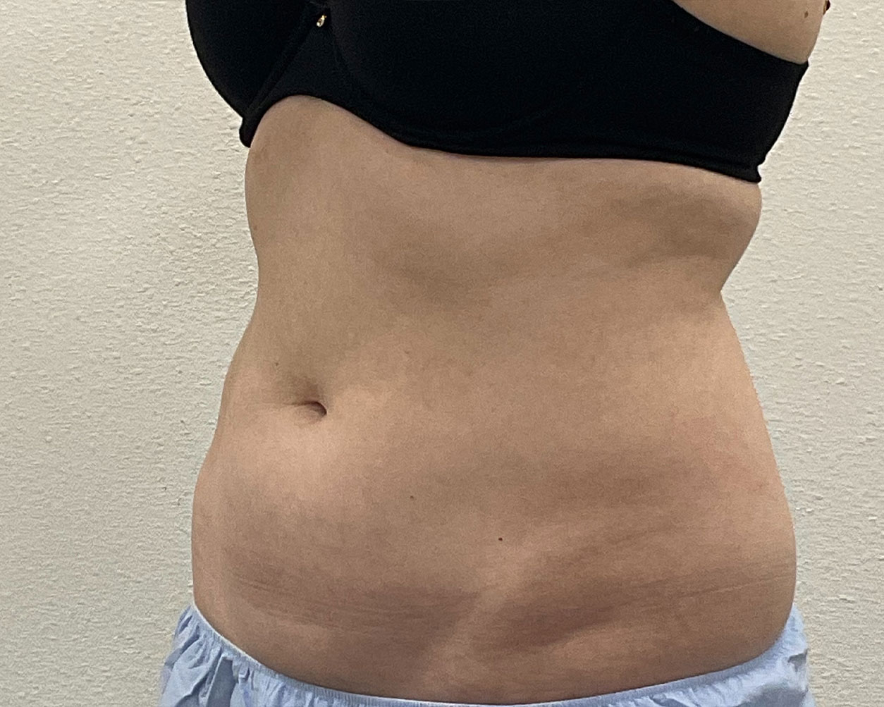 Coolsculpting Before & After Gallery - Patient 227052 - Image 7