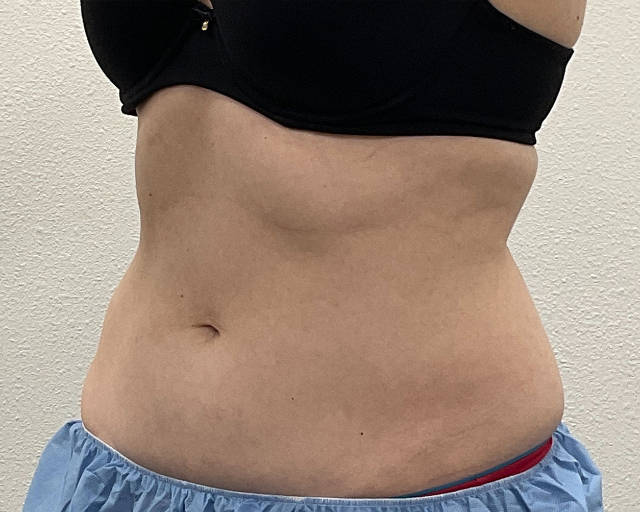 Coolsculpting Before & After Gallery - Patient 227052 - Image 8