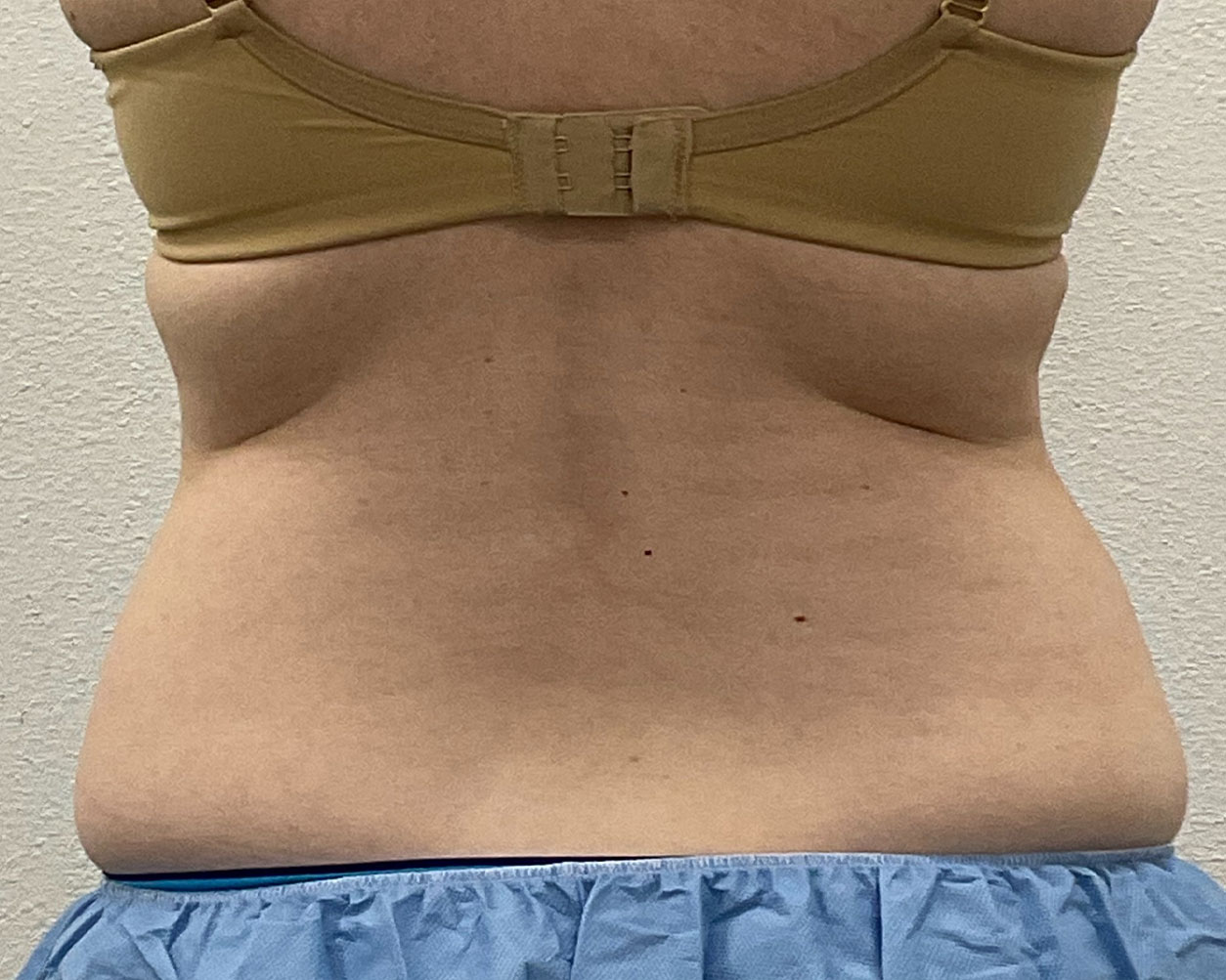 Coolsculpting Before & After Gallery - Patient 227052 - Image 10