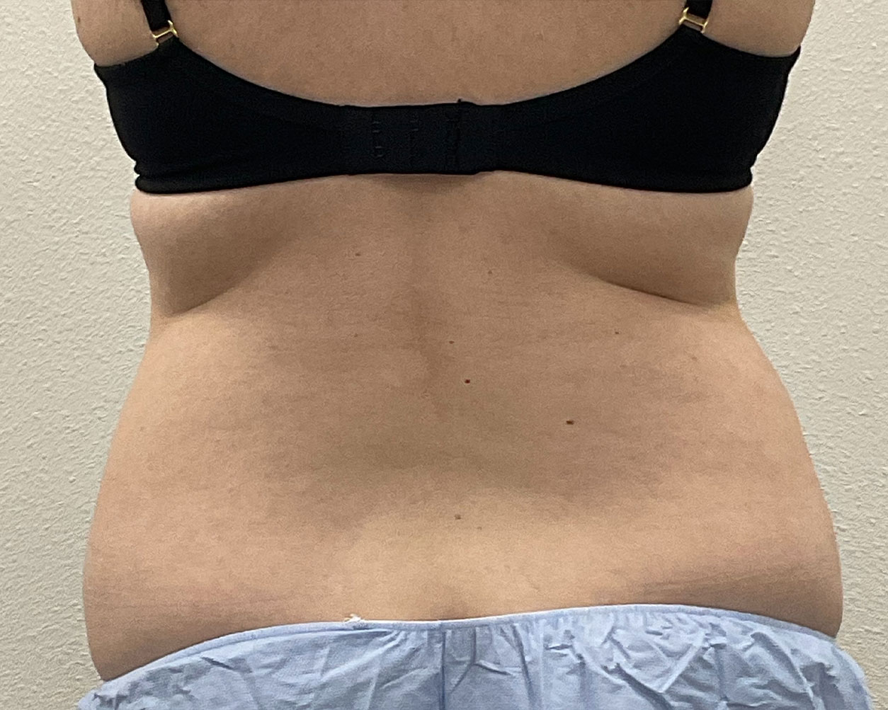 Coolsculpting Before & After Gallery - Patient 227052 - Image 11