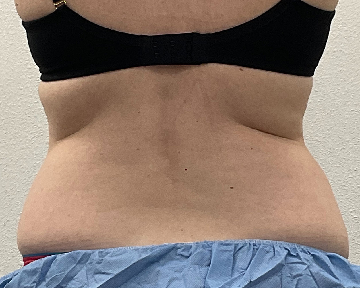 Coolsculpting Before & After Gallery - Patient 227052 - Image 12