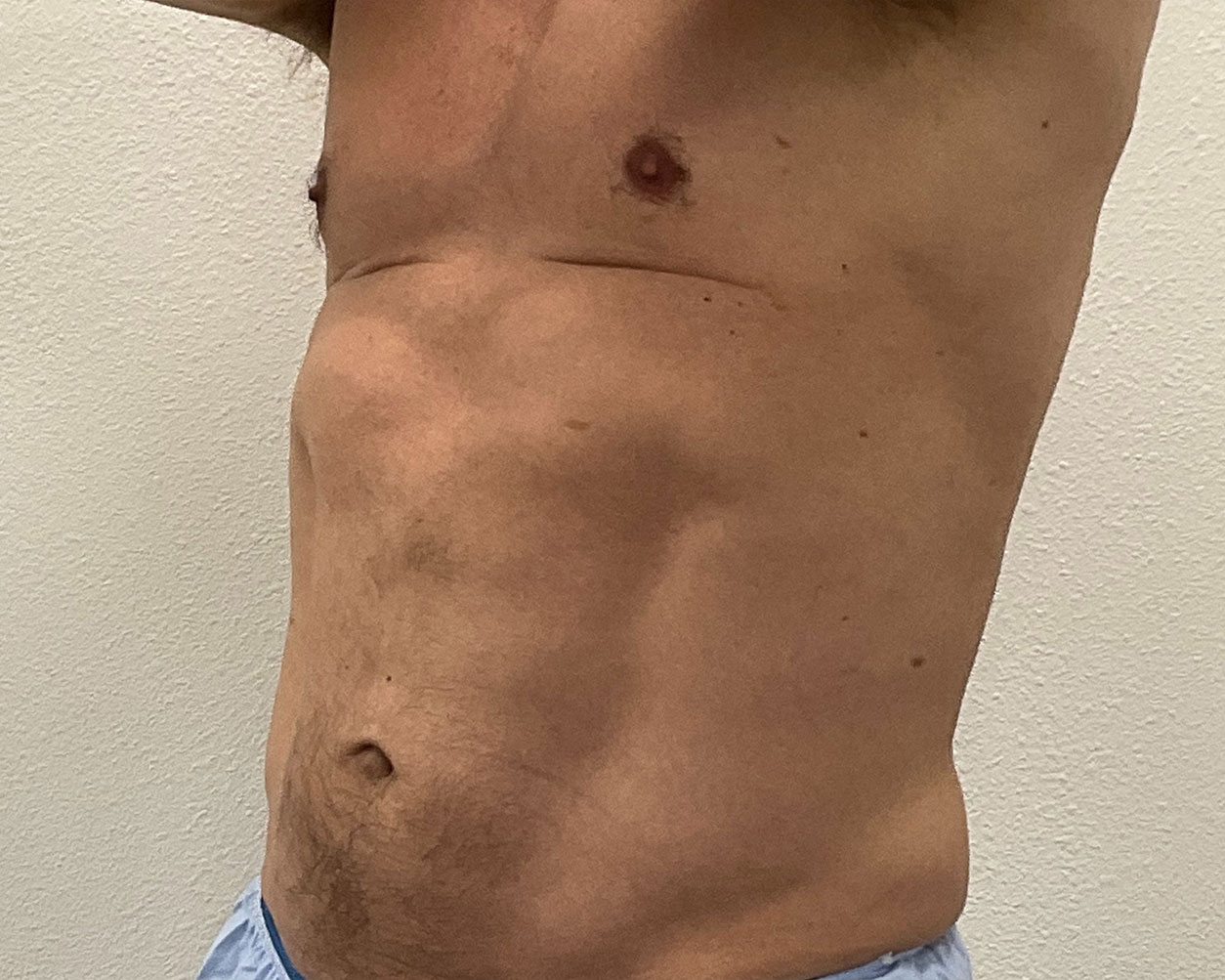 Coolsculpting Before & After Gallery - Patient 150838 - Image 2