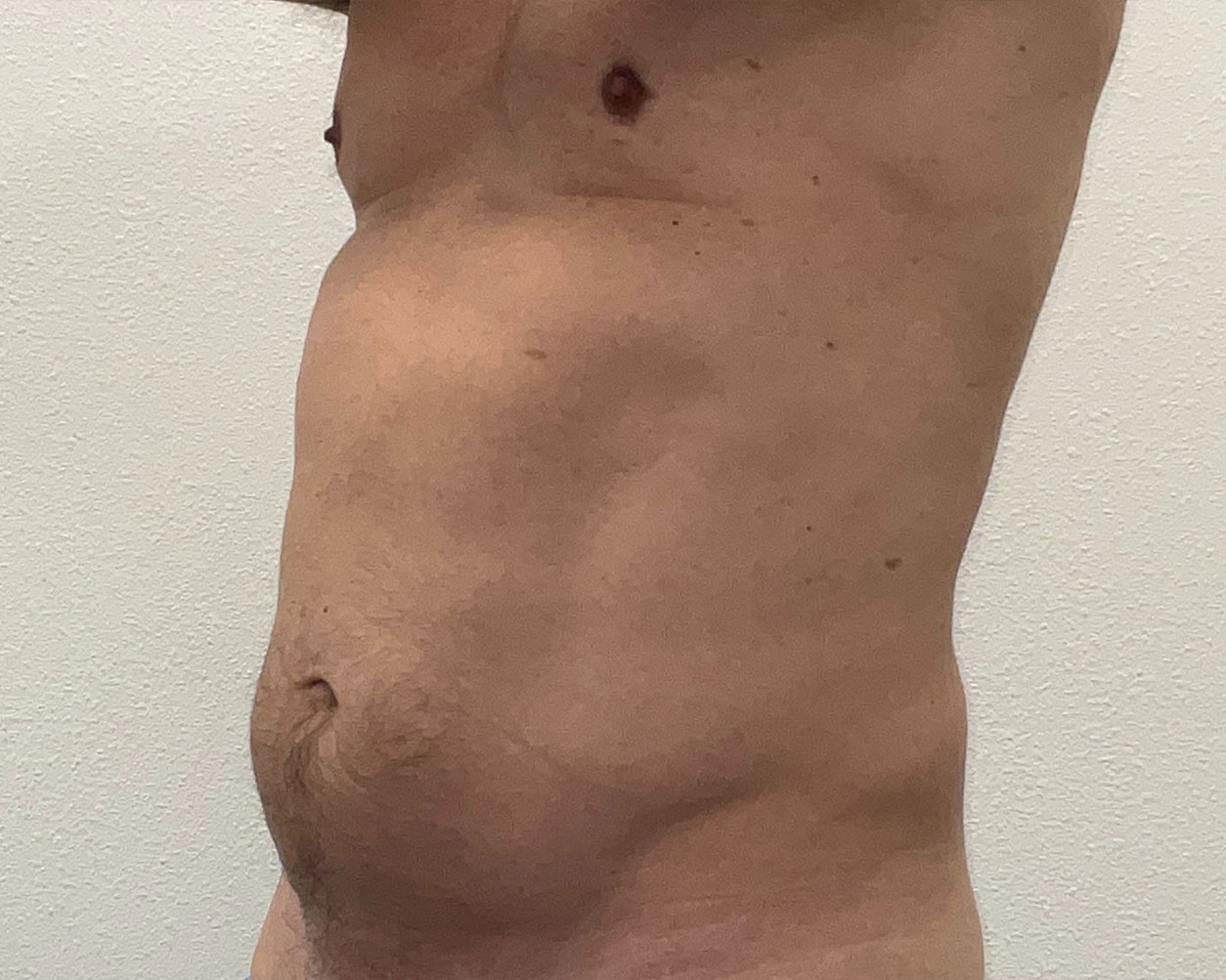 Coolsculpting Before & After Gallery - Patient 150838 - Image 3