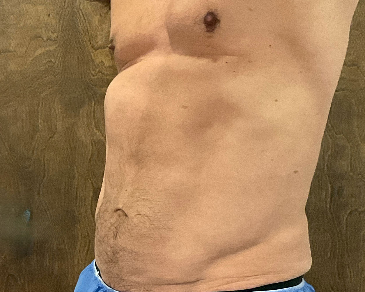 Coolsculpting Before & After Gallery - Patient 150838 - Image 4