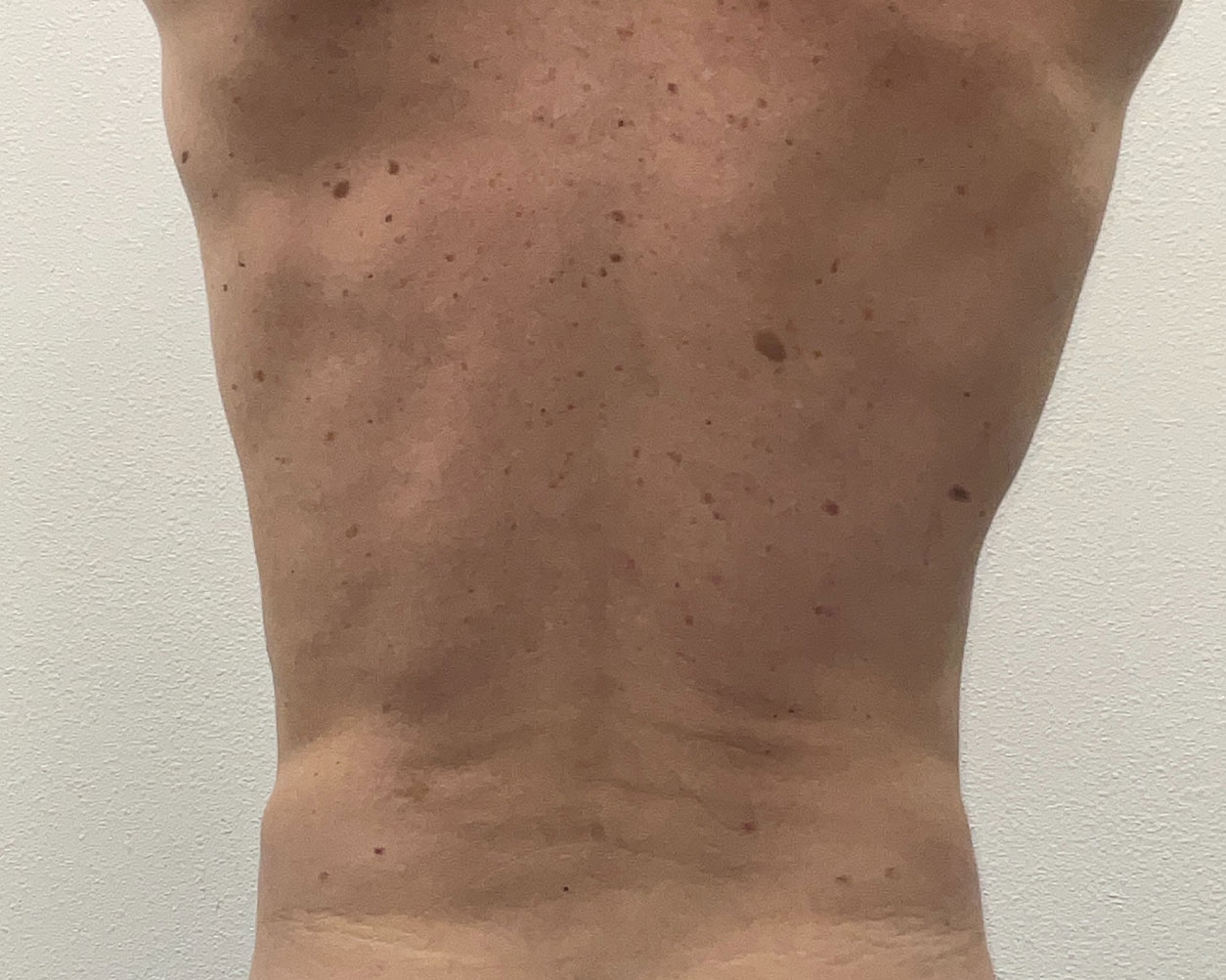 Coolsculpting Before & After Gallery - Patient 150838 - Image 6