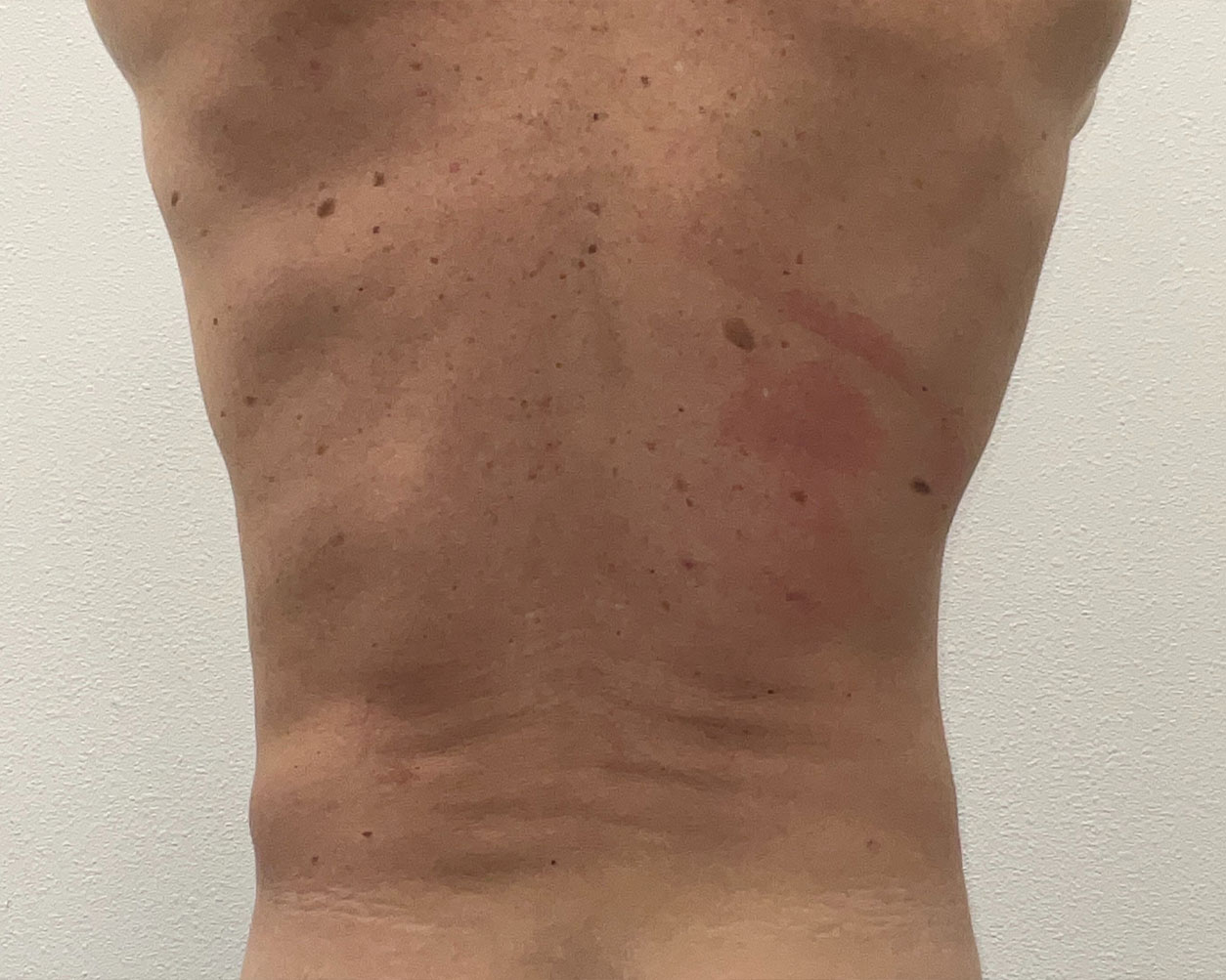 Coolsculpting Before & After Gallery - Patient 150838 - Image 7