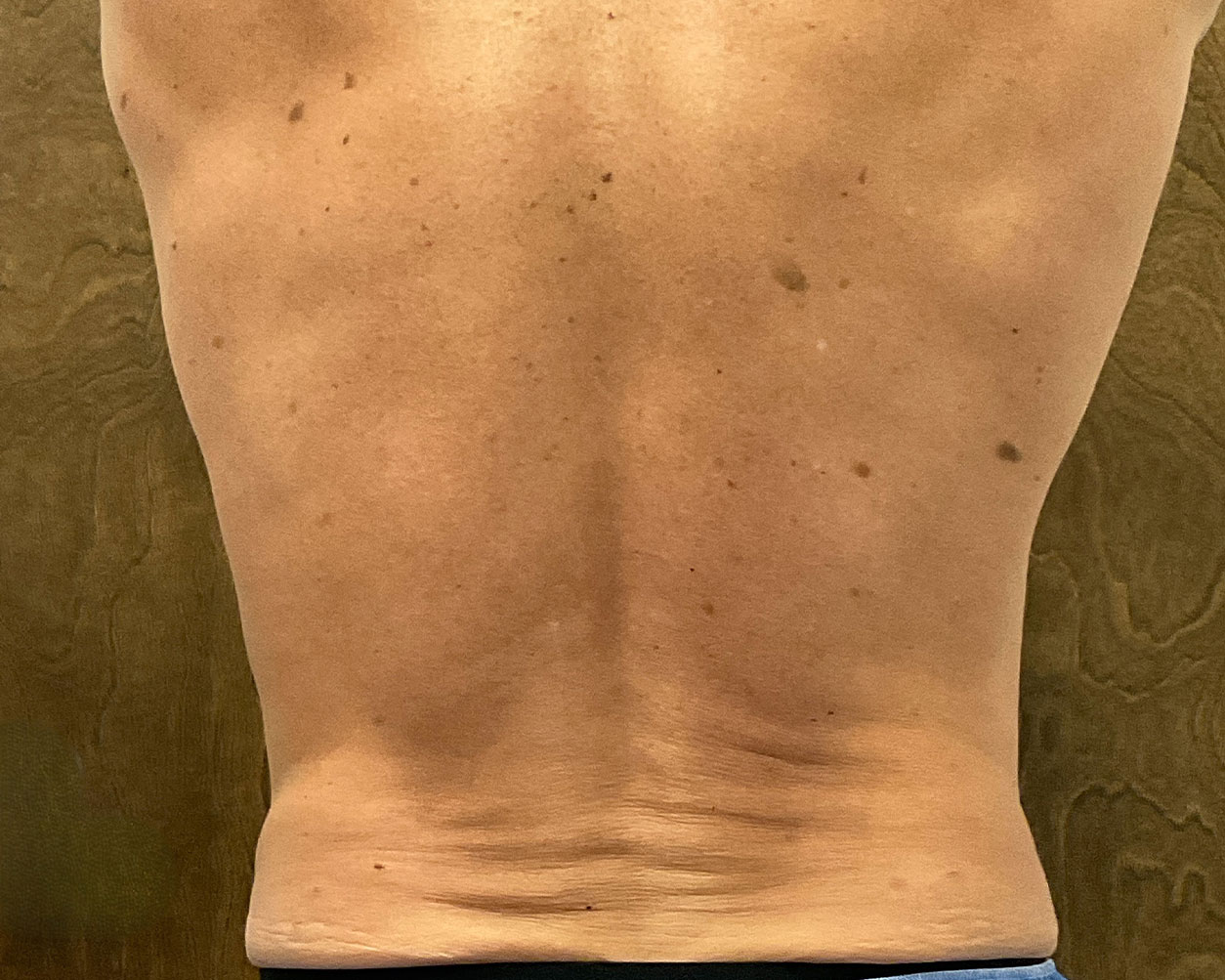 Coolsculpting Before & After Gallery - Patient 150838 - Image 8
