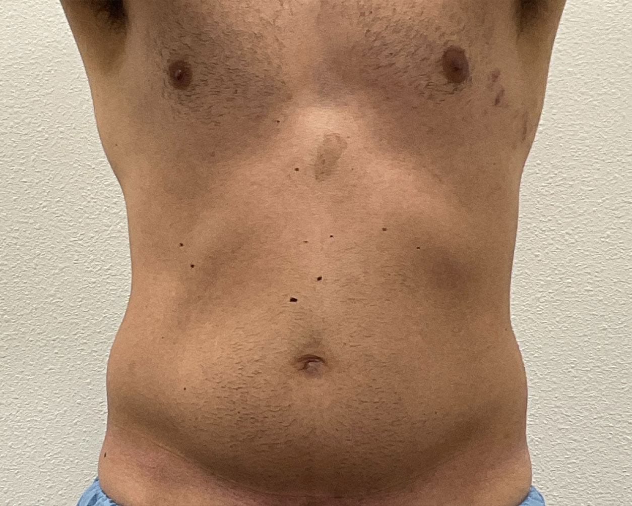 Coolsculpting Before & After Gallery - Patient 425103 - Image 1