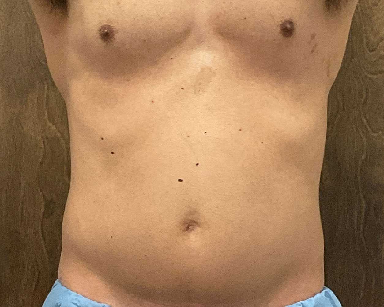 Coolsculpting Before & After Gallery - Patient 425103 - Image 4