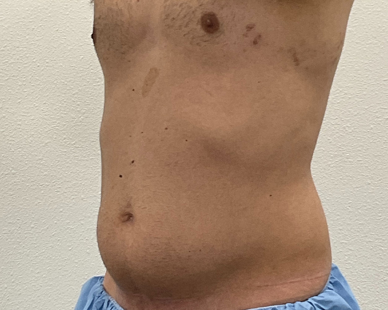 Coolsculpting Before & After Gallery - Patient 425103 - Image 6