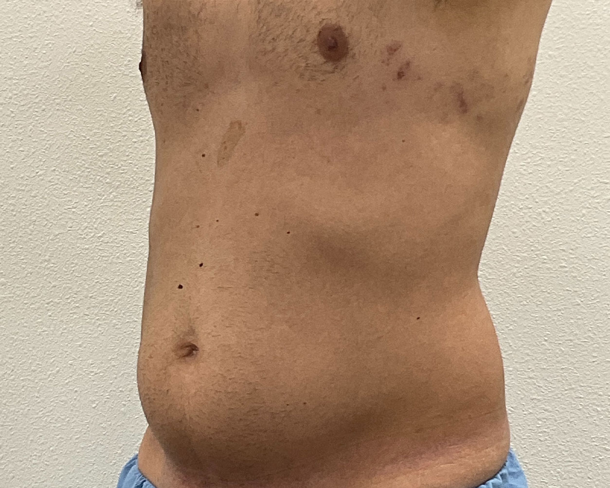 Coolsculpting Before & After Gallery - Patient 425103 - Image 7