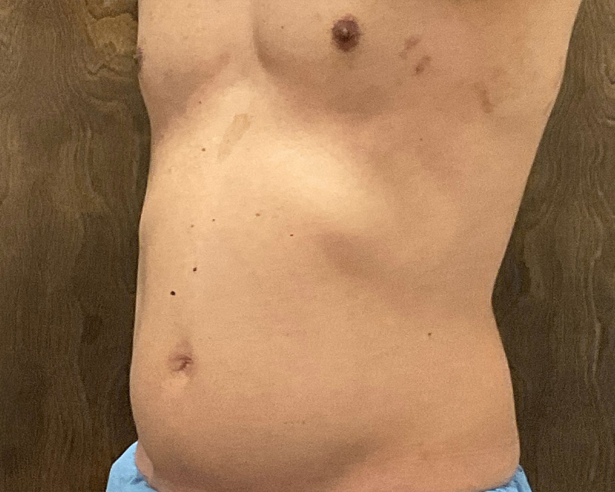 Coolsculpting Before & After Gallery - Patient 425103 - Image 8