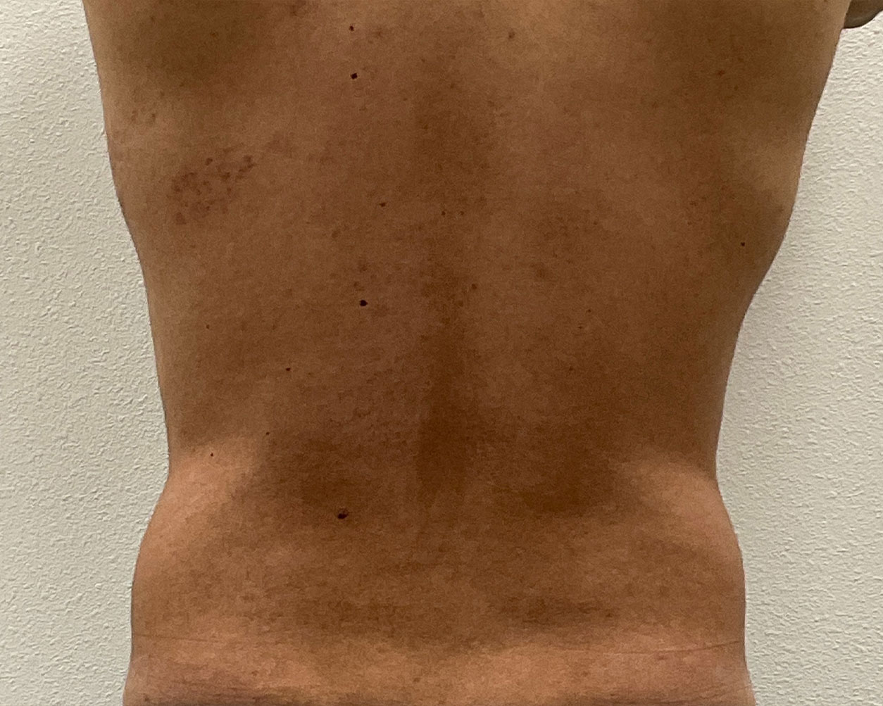 Coolsculpting Before & After Gallery - Patient 425103 - Image 9