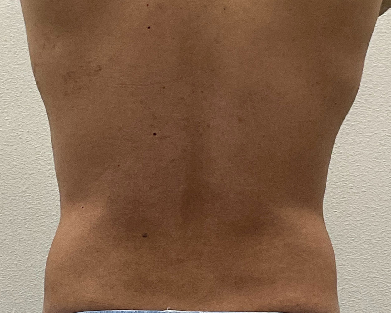 Coolsculpting Before & After Gallery - Patient 425103 - Image 10
