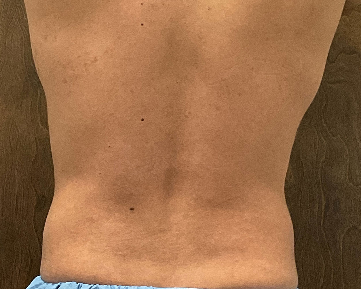 Coolsculpting Before & After Gallery - Patient 425103 - Image 12