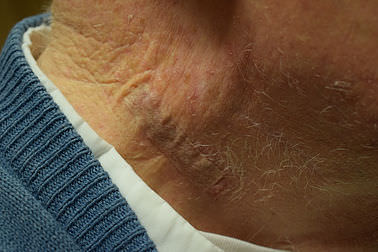an image of a bandage on an oder man's neck