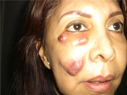 negative effects of botox on a woman