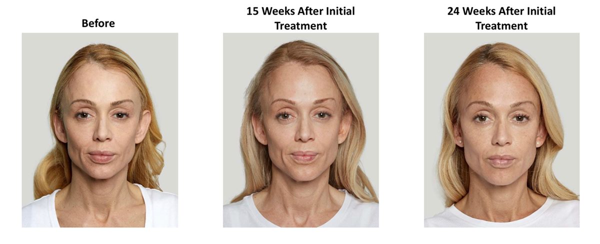 Frontal image of a patient after 24 weeks of sculptra treatment