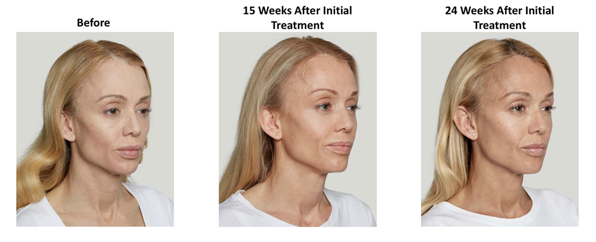 A side image of a patient after 24 weeks of sculptra treatment