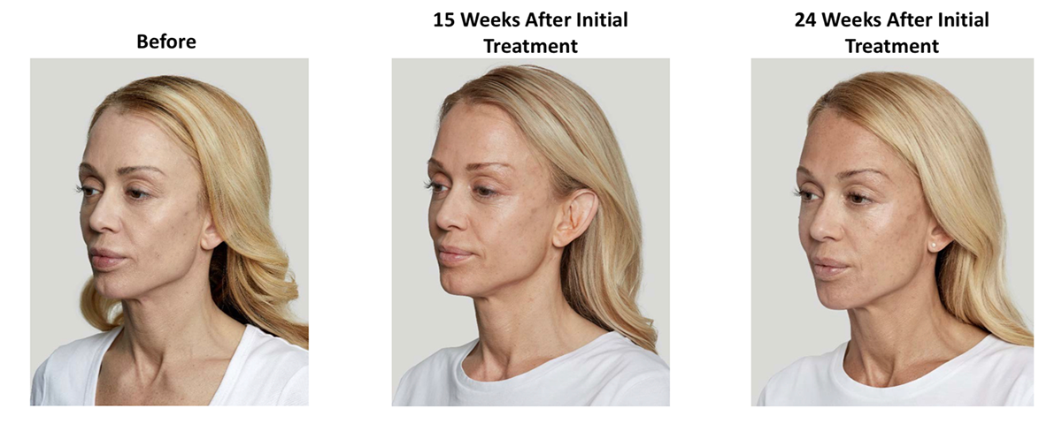 Side image of a patient after 24 weeks of sculptra treatment
