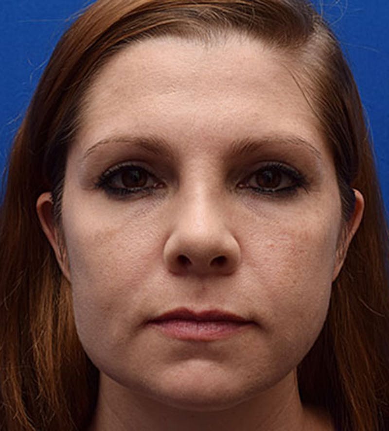 Face Before & After Gallery - Patient 63360258 - Image 1