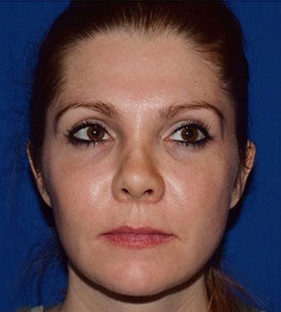 Face Before & After Gallery - Patient 63360258 - Image 2