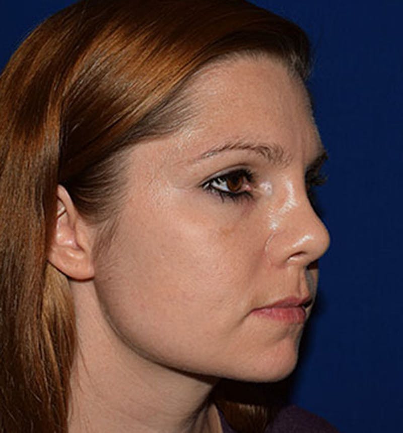 Face Before & After Gallery - Patient 63360258 - Image 3