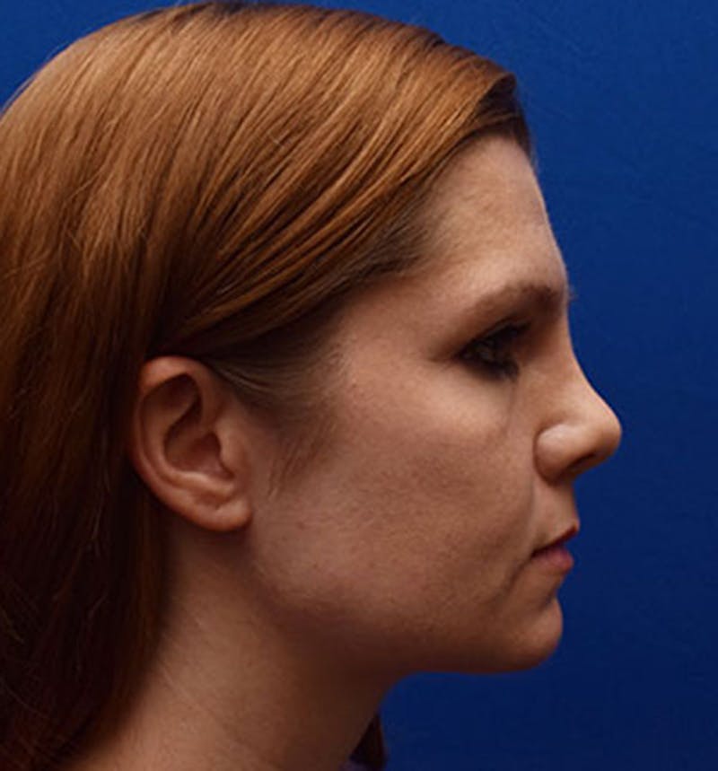 Face Before & After Gallery - Patient 63360258 - Image 5