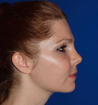 Face Before & After Gallery - Patient 63360258 - Image 6