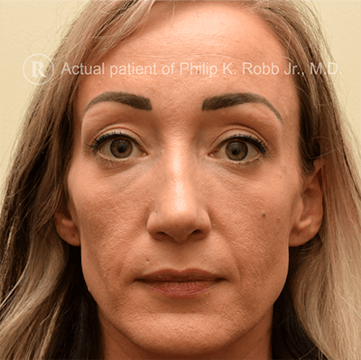 Face Before & After Gallery - Patient 63360260 - Image 1
