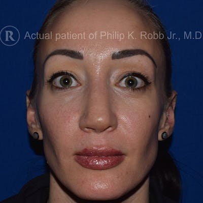 Face Before & After Gallery - Patient 63360260 - Image 2