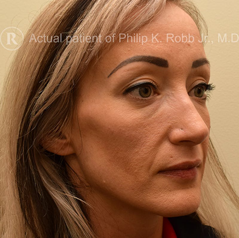 Face Before & After Gallery - Patient 63360260 - Image 3