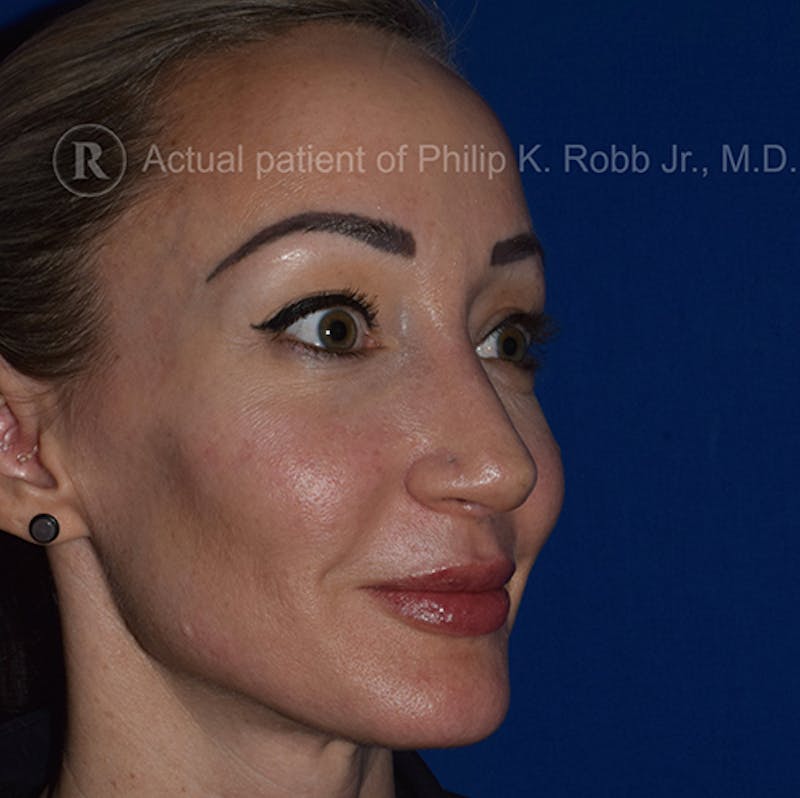 Cosmetic Surgical Before & After Gallery - Patient 63360260 - Image 4