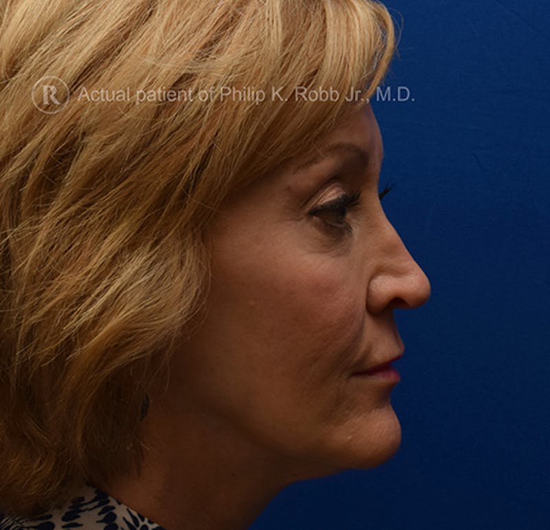 Face Before & After Gallery - Patient 63360263 - Image 1
