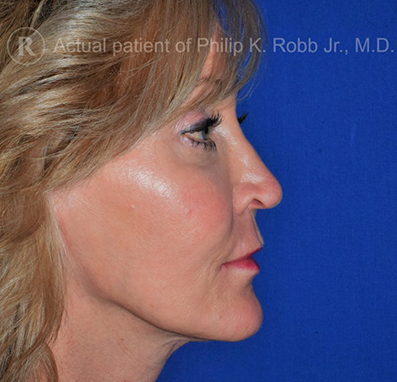 Face Before & After Gallery - Patient 63360263 - Image 2