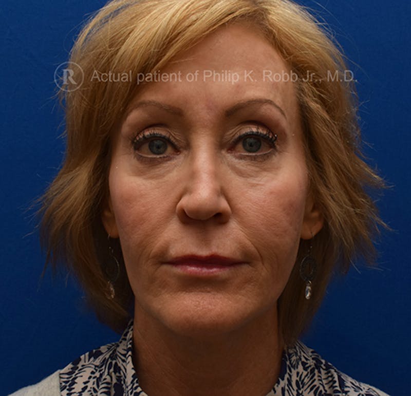 Face Before & After Gallery - Patient 63360263 - Image 3