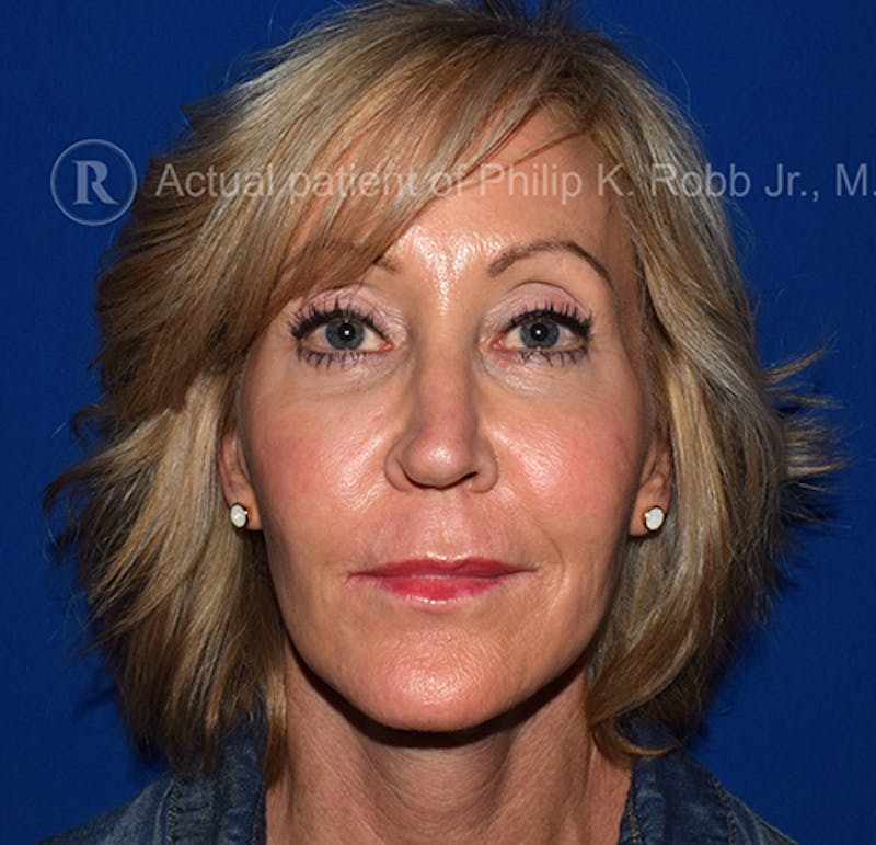 Face Before & After Gallery - Patient 63360263 - Image 4