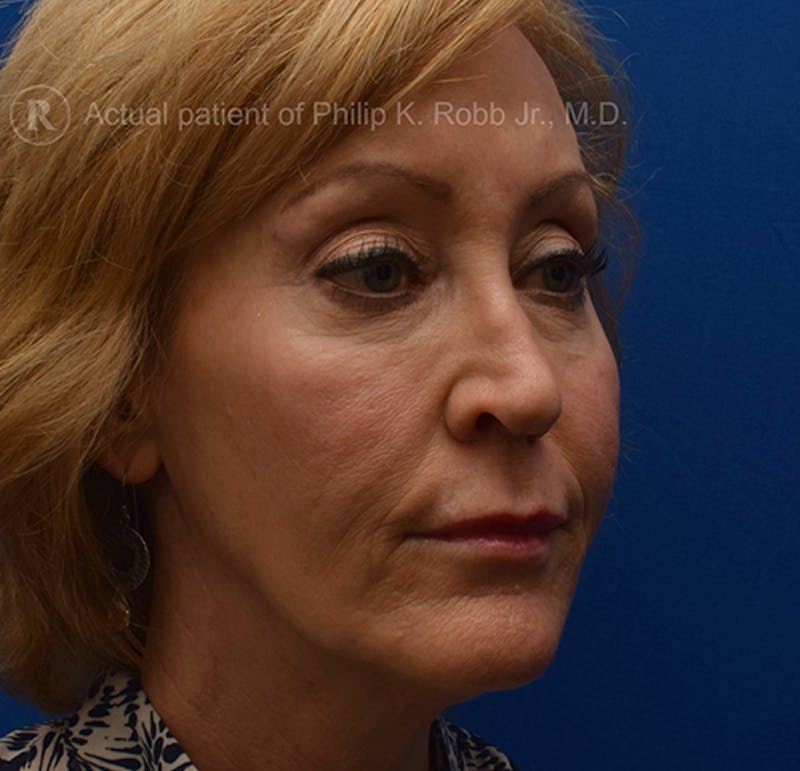 Face Before & After Gallery - Patient 63360263 - Image 5