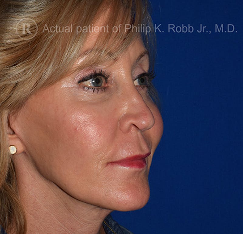 Face Before & After Gallery - Patient 63360263 - Image 6