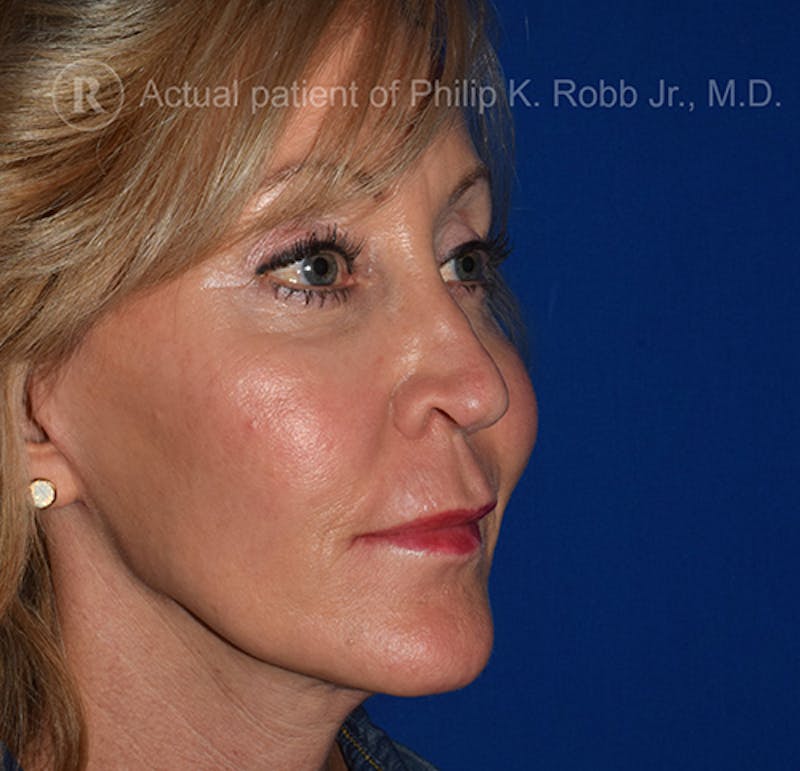 Cosmetic Surgical Before & After Gallery - Patient 63360263 - Image 6